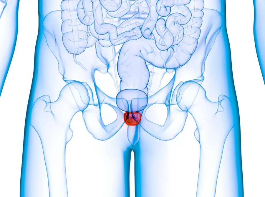 Câncer de Próstata: Conheça a Doença, Seus Estágios e Por Que o Diagnóstico Precoce Salva Vidas